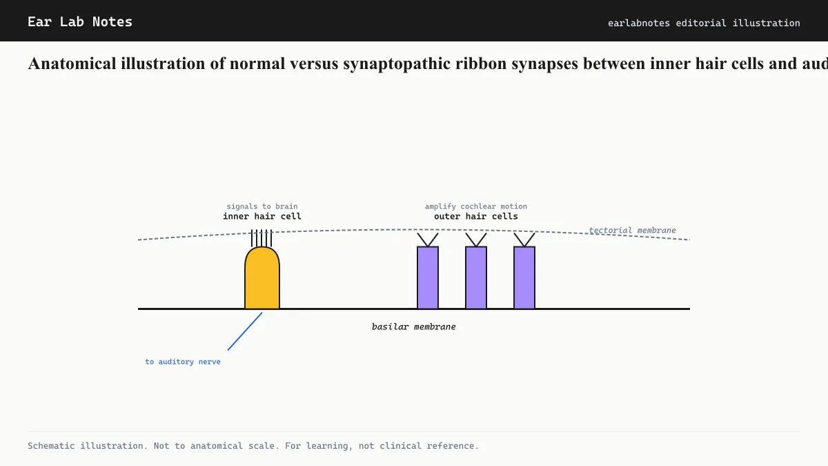 Anatomical illustration of normal versus synaptopathic ribbon synapses between inner hair cells and auditory neurons.
