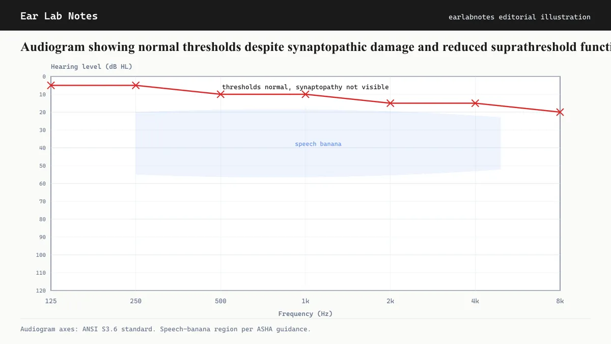 Audiogram showing normal thresholds despite synaptopathic damage and reduced suprathreshold function.