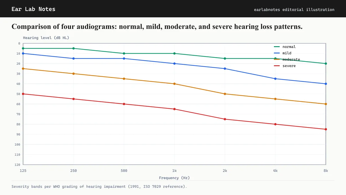Comparison of four audiograms: normal, mild, moderate, and severe hearing loss patterns.