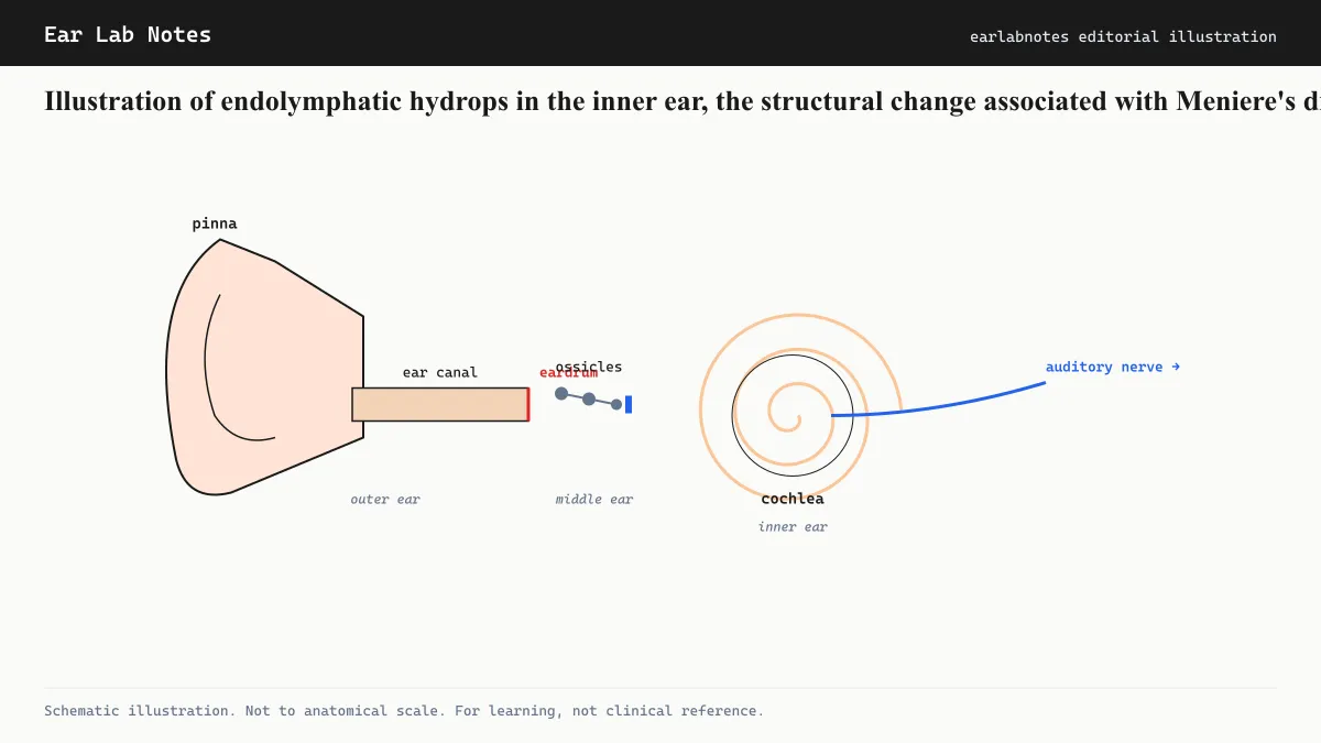 Illustration of endolymphatic hydrops in the inner ear, the structural change associated with Meniere's disease.