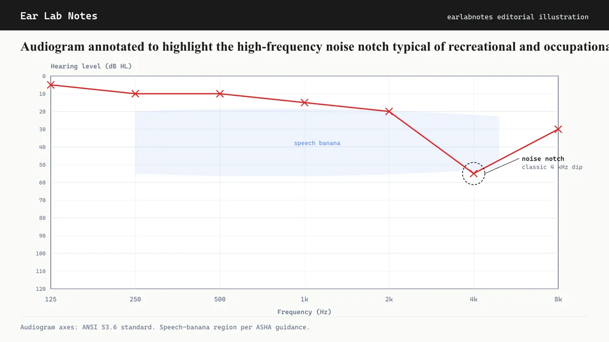 Audiogram annotated to highlight the high-frequency noise notch typical of recreational and occupational noise exposure.