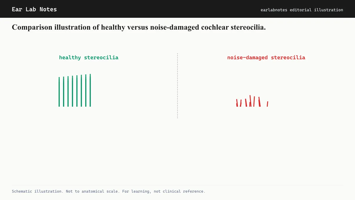 Comparison illustration of healthy versus noise-damaged cochlear stereocilia.