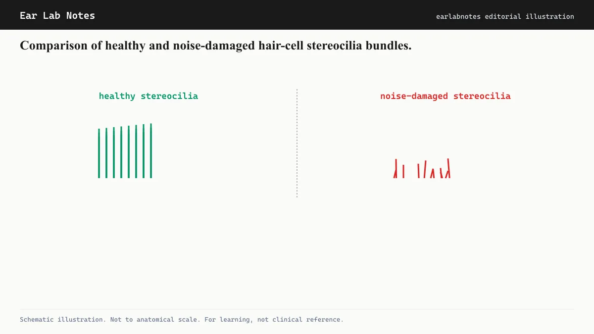 Comparison of healthy and noise-damaged hair-cell stereocilia bundles.