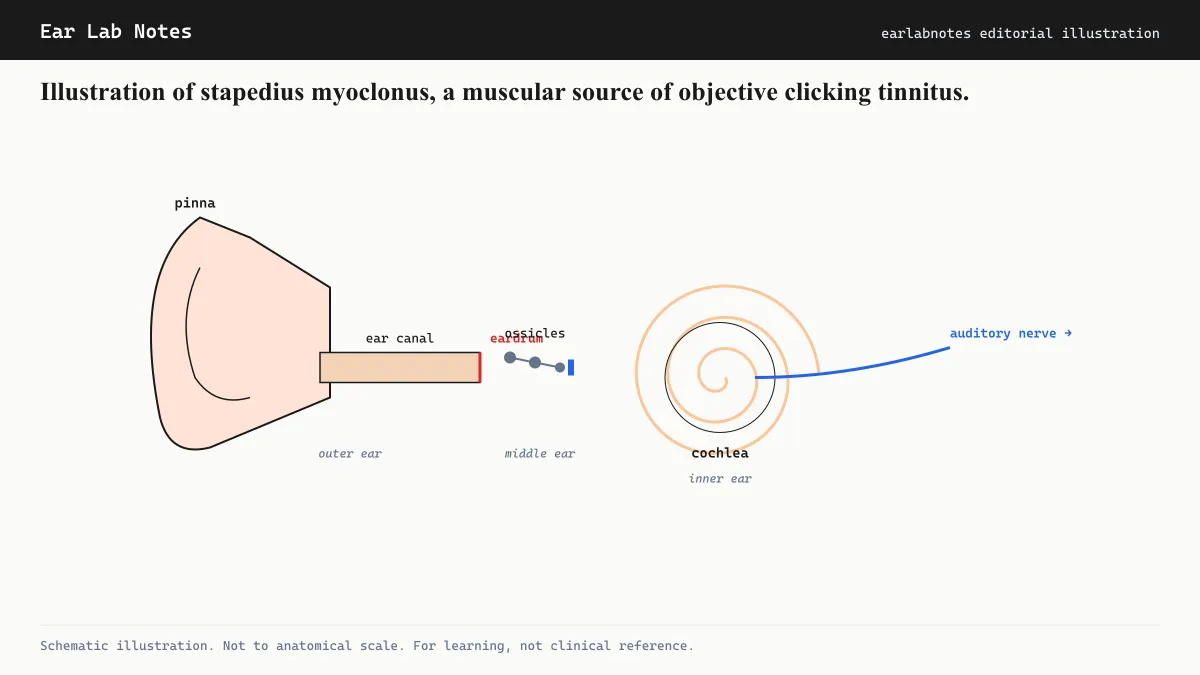 Illustration of stapedius myoclonus, a muscular source of objective clicking tinnitus.